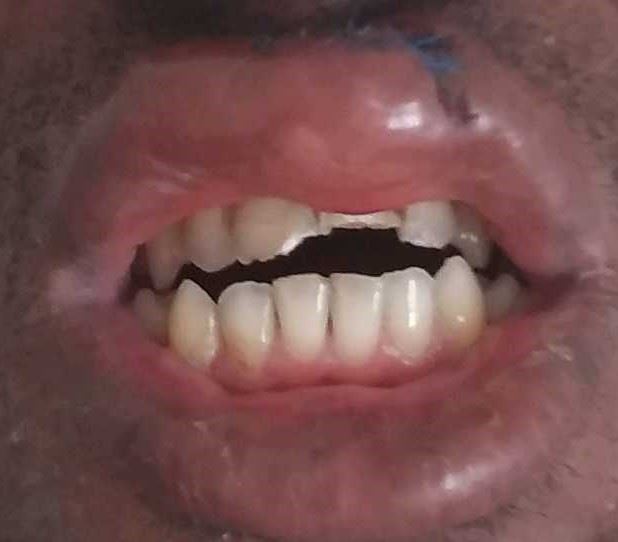 Chipped and broken teeth from scooter accident